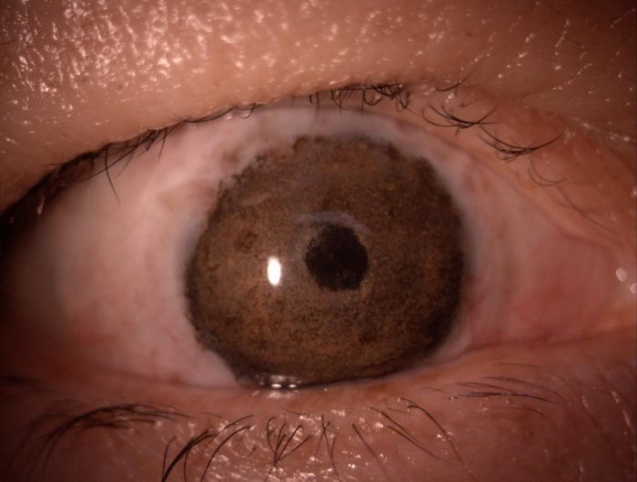 Queratopigmentación: el "tatuaje corneal" que devuelve la apariencia natural al ojo