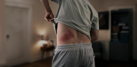 Mitos y verdades sobre el herpes zóster: síntomas, contagio, riesgos y complicaciones