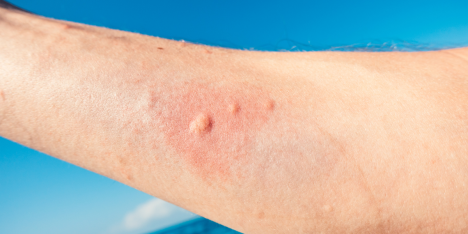 Verano y picaduras de insectos: recomendaciones para prevenir riesgos y complicaciones