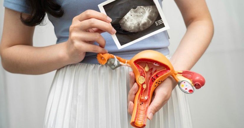 Endometriosis: síntomas, diagnóstico tardío y por qué no se debe normalizar el dolor menstrual