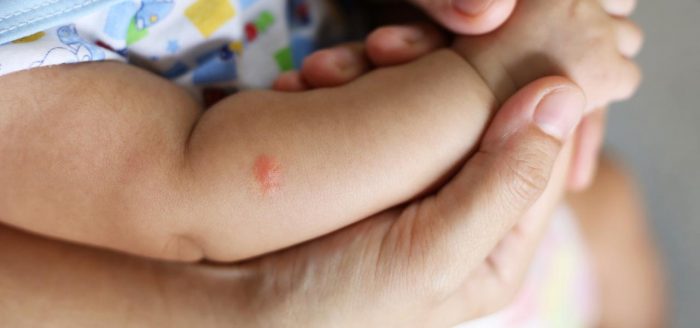 ¿Por qué algunas personas reaccionan más a las picaduras de zancudos o mosquitos?