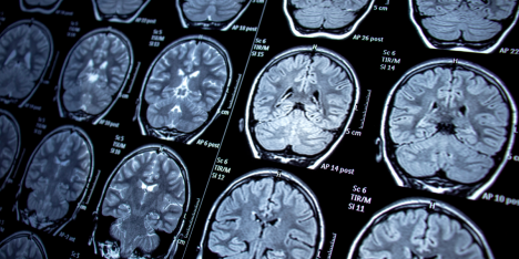 Epilepsia: claves para reconocerla y enfrentar una crisis de forma segura