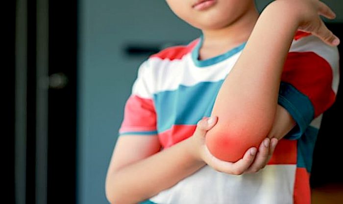 Revelan vínculo clave entre obesidad infantil, rendimiento físico y salud ósea