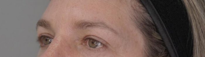 Blefaroplastia: la cirugía para corregir el párpado caído se posiciona entre las más demandas