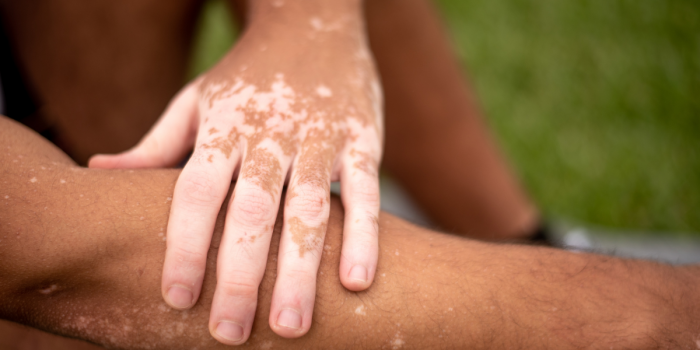 Vitiligo: síntomas, factores de riesgo y tratamientos para una enfermedad autoinmune