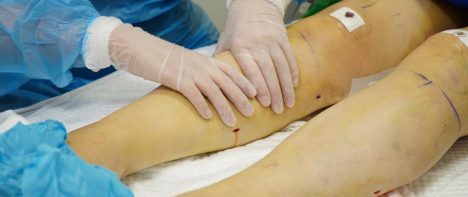 ¿Lipedema o sobrepeso? 7 enfermedades con las que se confunde esta condición que afecta a mujeres