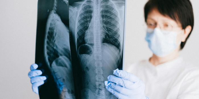 Cáncer pulmonar en Chile: la “enfermedad invisible” que lidera las muertes por cáncer