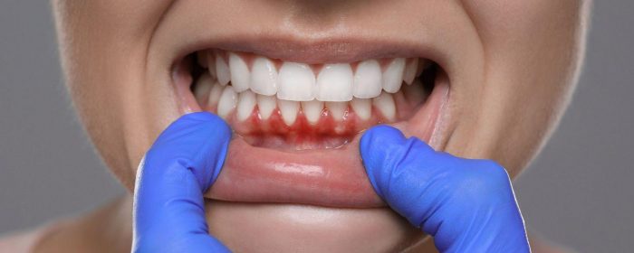 Enfermedad de las encías: cómo afecta al corazón y dificulta el control de la diabetes