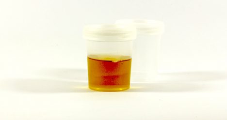 ¿Qué dice el color de la orina sobre tu salud? Guía para identificar señales de alerta