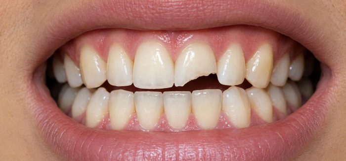 Fracturas dentales en Fiestas Patrias: cómo prevenirlas y qué hacer