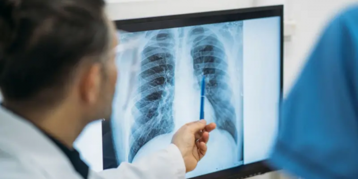Qué es un adenocarcinoma pulmonar, el tipo de tumor maligno que le extirparon al papa León XIV
