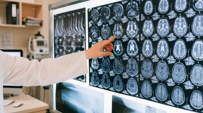 Método FAST: cómo identificar los síntomas de un ACV y actuar a tiempo