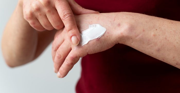 Dermatitis atópica: cuáles son sus síntomas, cómo cuidar la piel y cuándo consultar