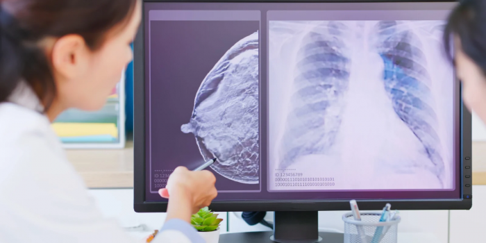 Cáncer de mama: cómo influyen la alimentación y la actividad física en el riesgo